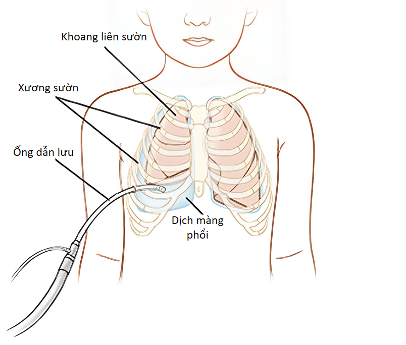 Đặt dẫn lưu khí và dịch màng phổi ở trẻ em