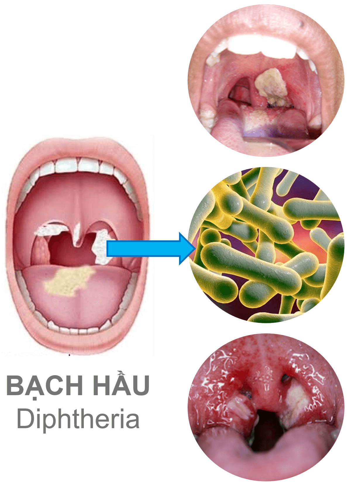 Bạch hầu (Diphtheria)