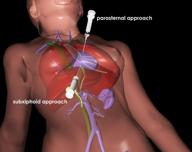 Chọc dịch màng tim 1