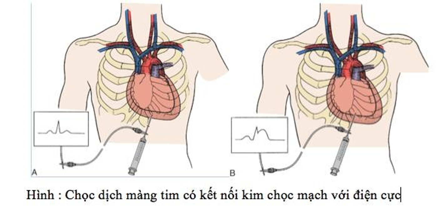 Chọc dịch màng tim 3