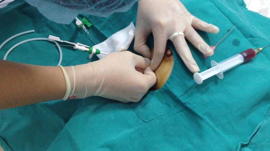 Dẫn lưu với sheath