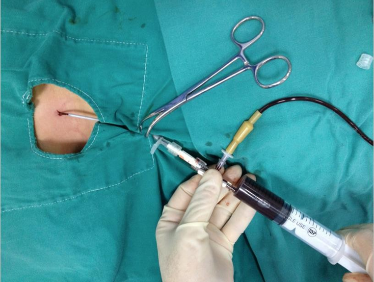 Kết nối chai dẫn lưu 2