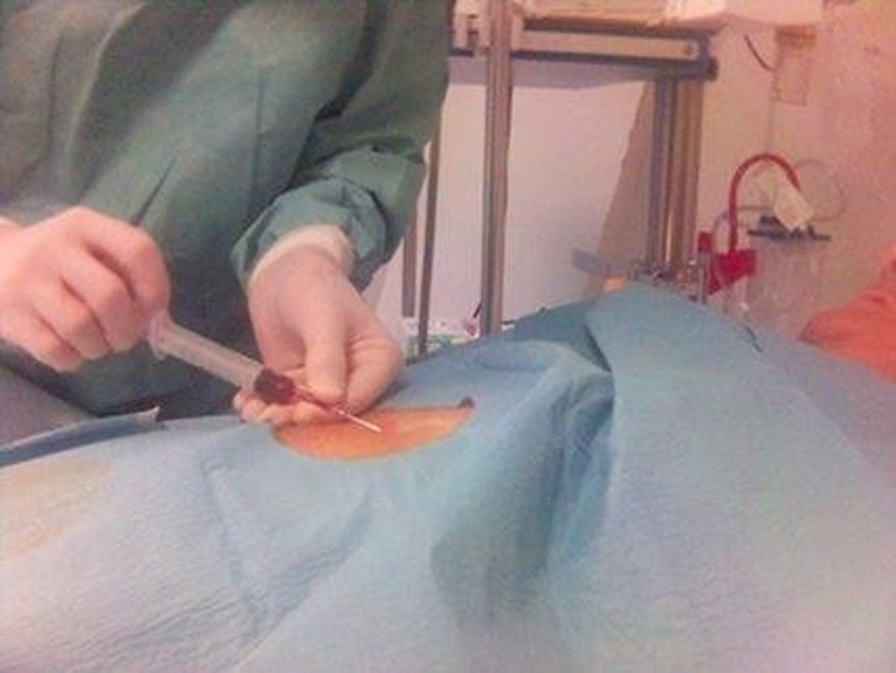 Hút dịch màng tim