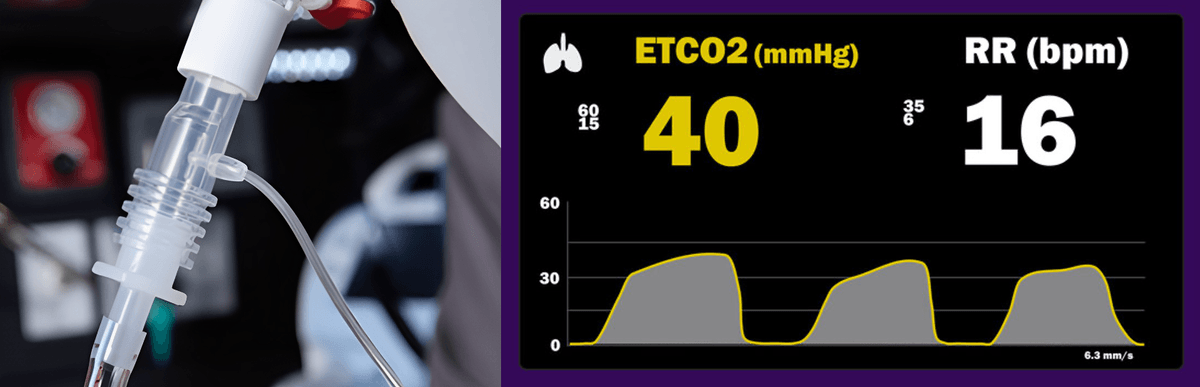 Theo dõi ETCO2 liên tục tại giường ở trẻ em