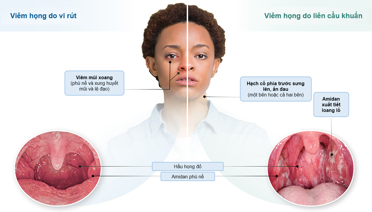 Viêm họng do liên cầu nhóm A ở người lớn và trẻ em