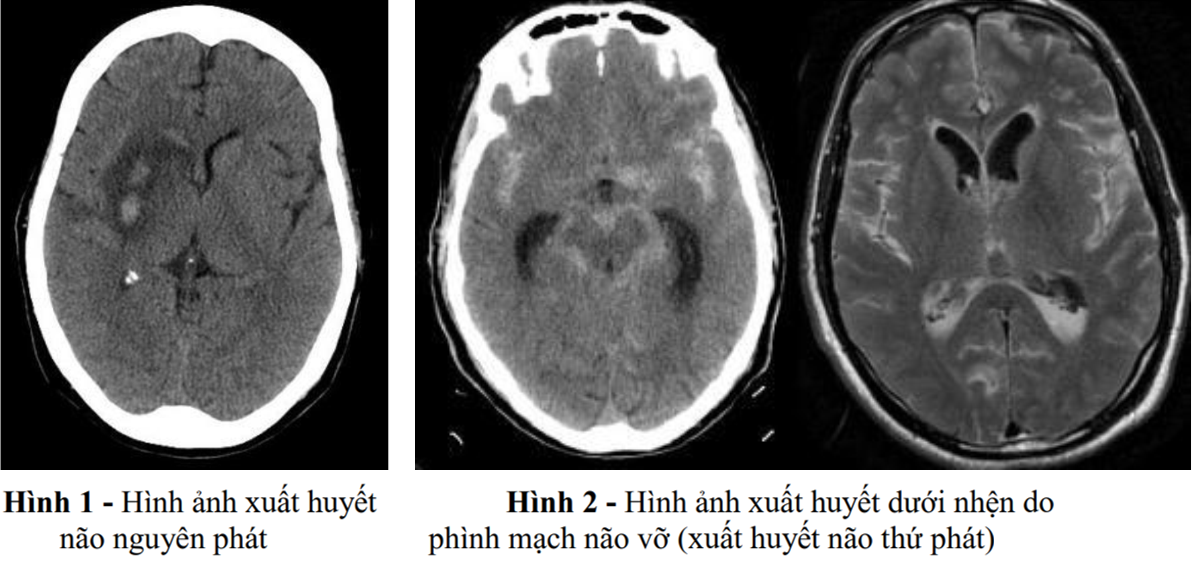 Xuất huyết não nguyên phát và xuất huyết não thứ phát.