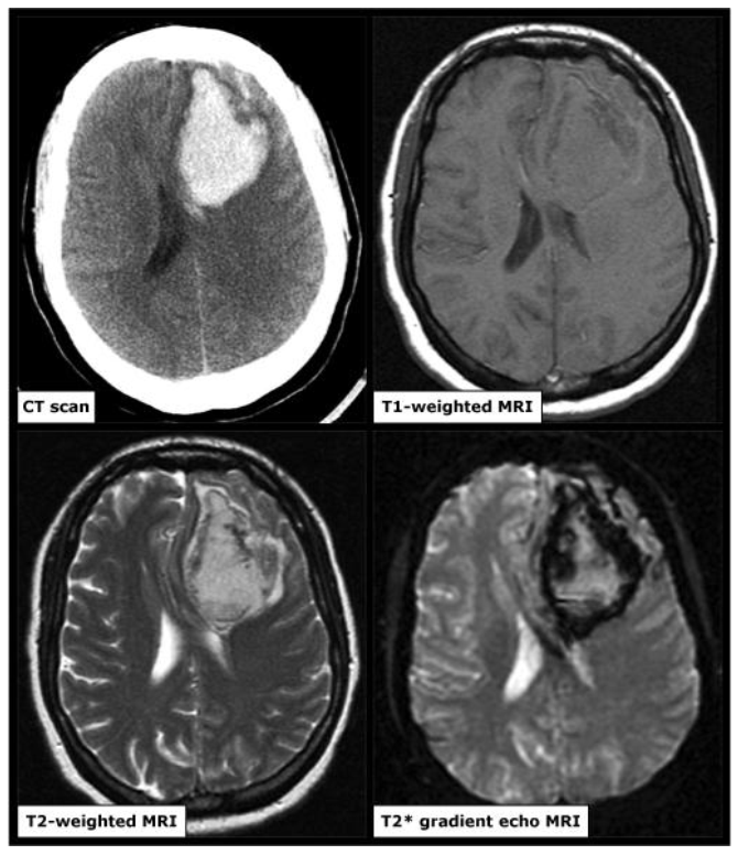 Hình ảnh CT và MRI của một bệnh nhân xuất huyết não cấp