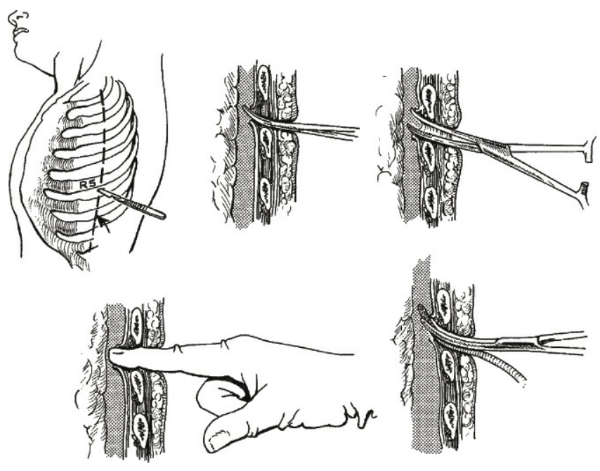 Thủ thuật đặt sonde dẫn lưu màng phổi