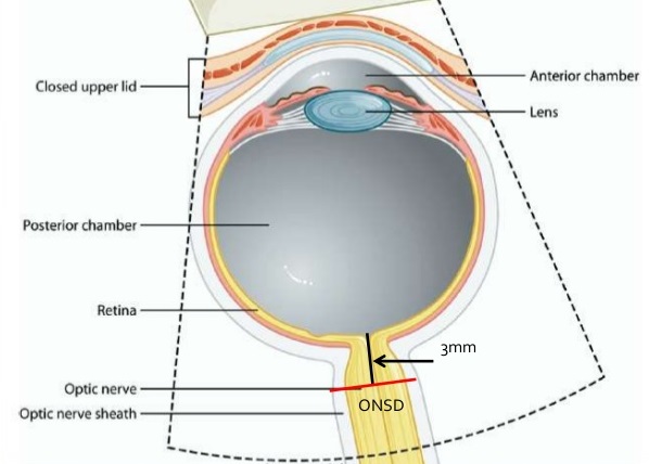 Siêu âm đo đường kính ống thần kinh thị giác (ONSD)