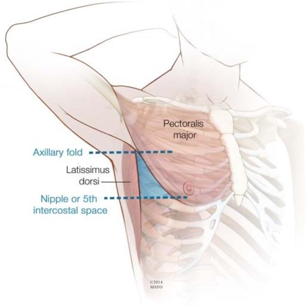 Chèn ống ngực (đặt ống dẫn lưu màng phổi)