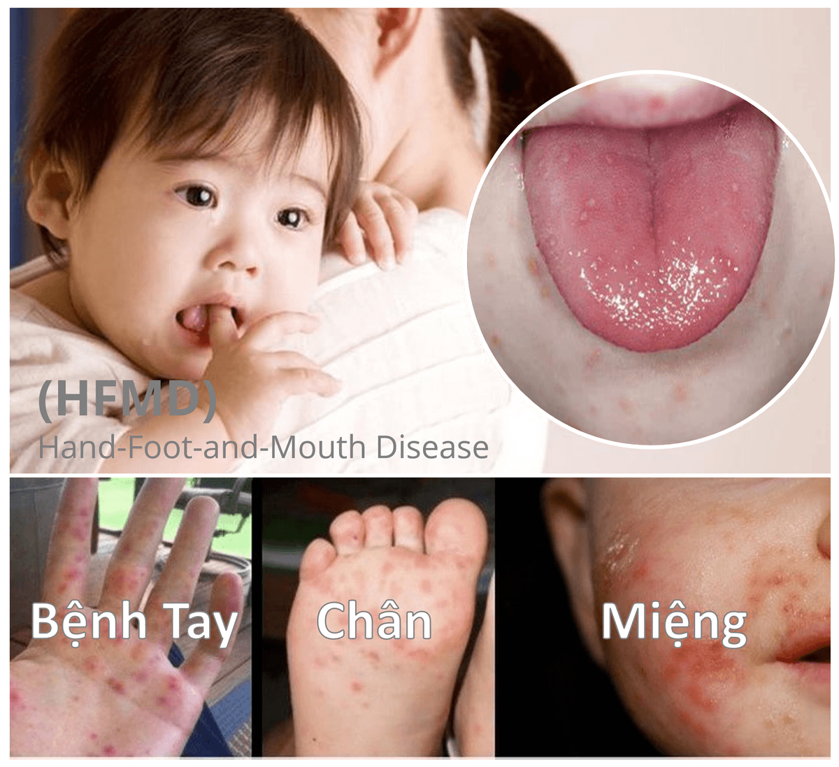 Tay chân miệng