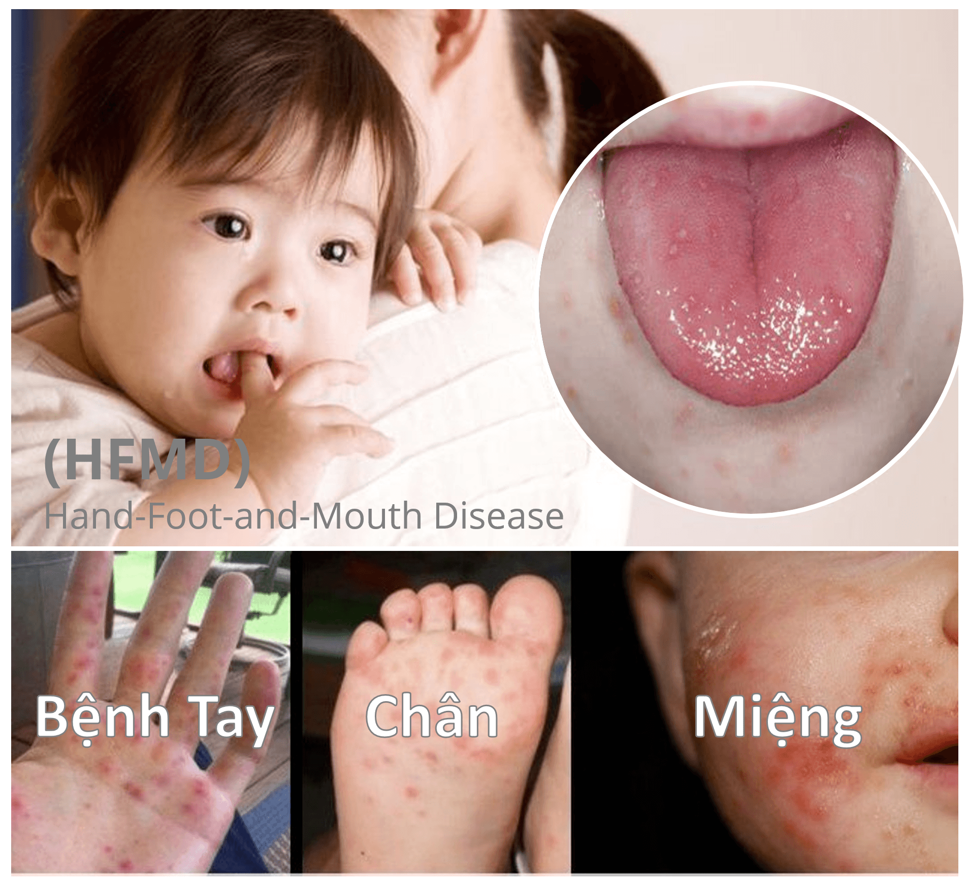 Bệnh tay chân miệng