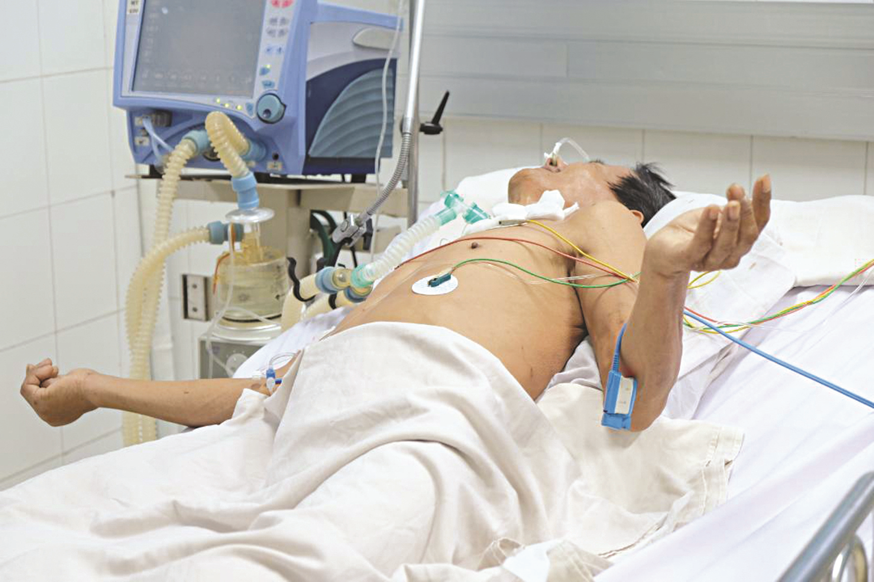 Bệnh Uốn ván (Tetanus)