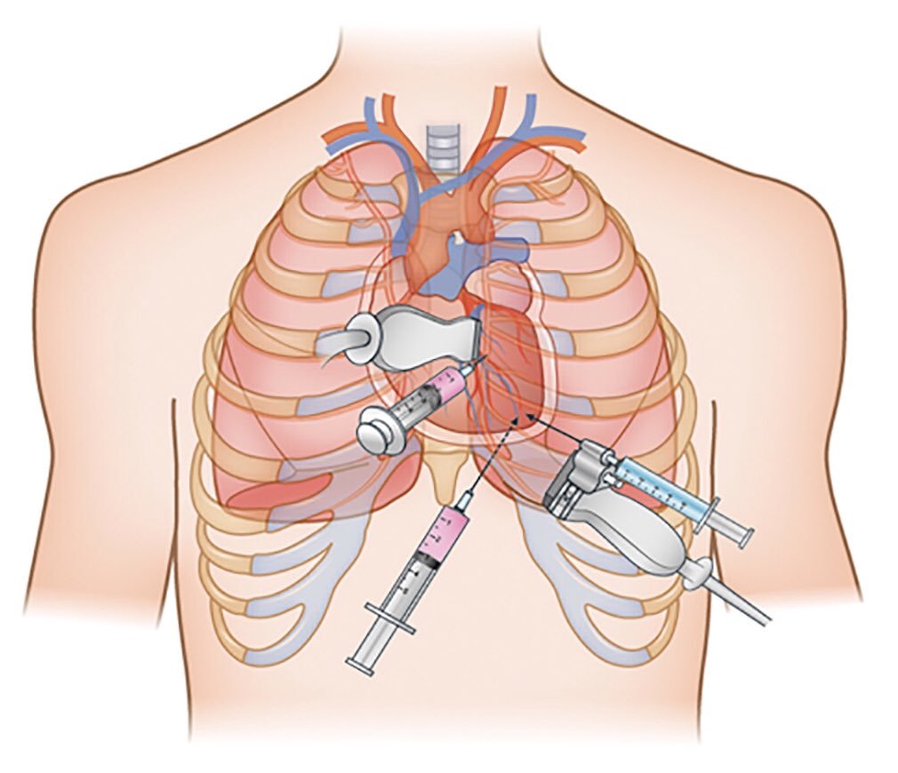 Chọc hút dịch màng tim cấp cứu
