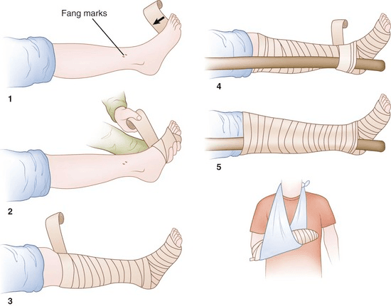 Kỹ thuật băng ép bất động sơ cứu rắn cắn