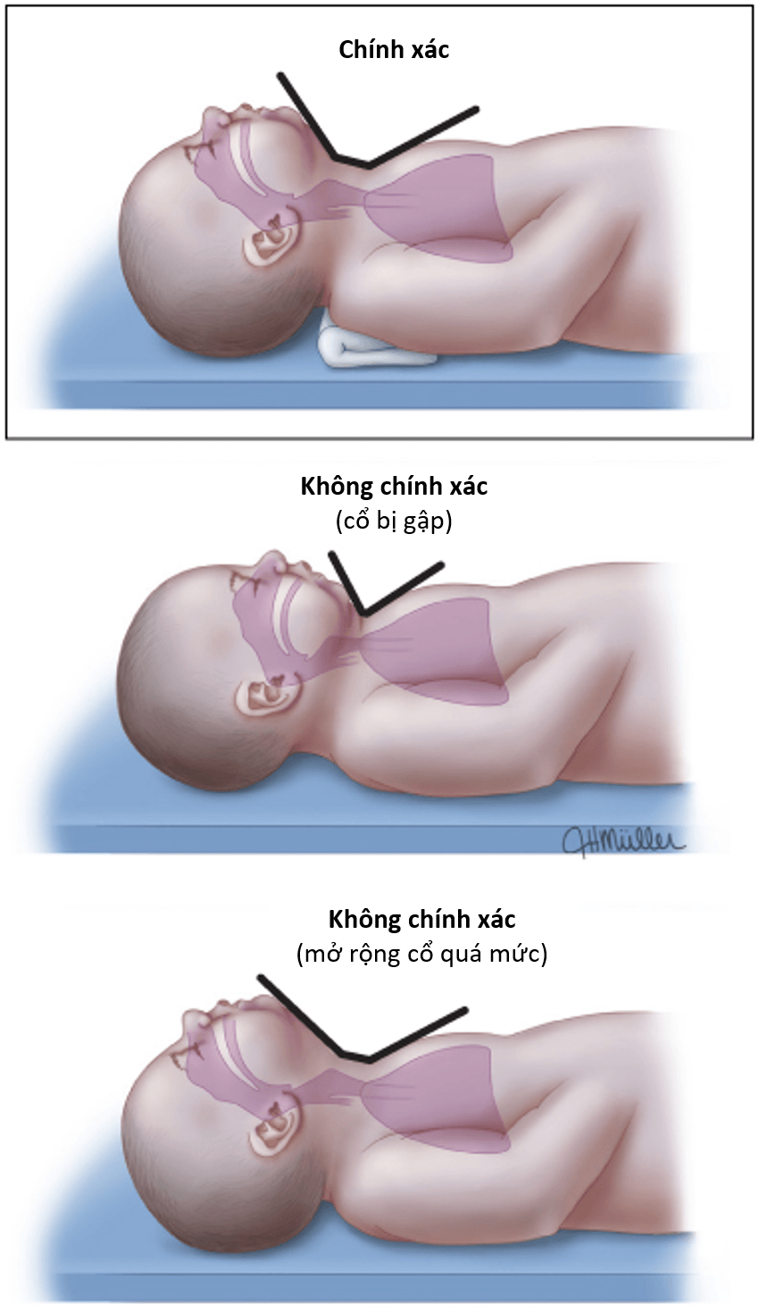 Tư thế đầu chính xác