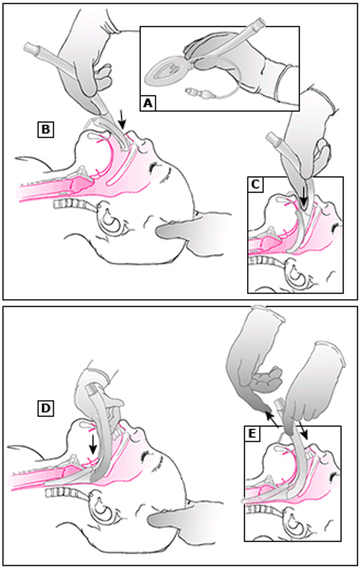 Kỹ thuật đặt LMA