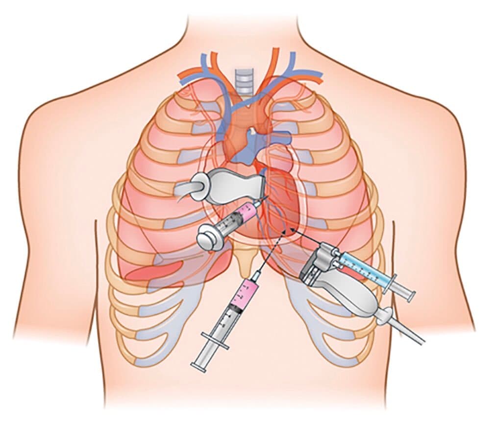 Chọc hút dịch màng tim cấp cứu